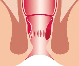 Hämorrhoiden Grad 1 Hämorrhoiden Grad 1