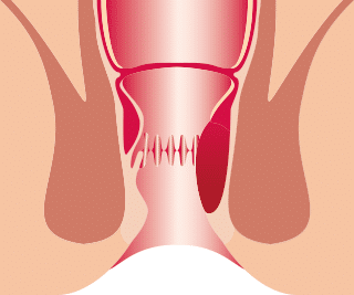 Hämorrhoiden Grad 2 Hämorrhoiden Grad 2