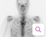 Diagnoseverfahren bei metastasiertem Brustkrebs: Skelettszintigraphie Diagnoseverfahren bei metastasiertem Brustkrebs: Skelettszintigraphie