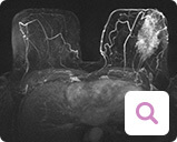 Magnetresonanztomographie (MRT) der Brust Magnetresonanztomographie (MRT) der Brust