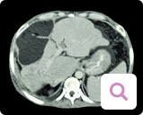 Diagnoseverfahren bei metastasiertem Brustkrebs: Computertomographie Diagnoseverfahren bei metastasiertem Brustkrebs: Computertomographie