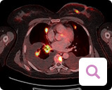 Diagnoseverfahren bei metastasiertem Brustkrebs: CT Diagnoseverfahren bei metastasiertem Brustkrebs: CT