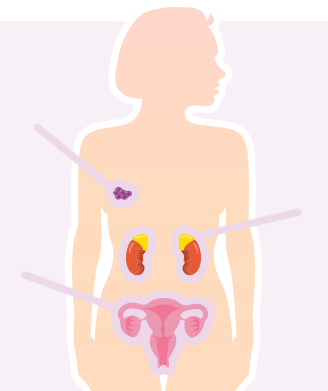 Metastasierter Brustkrebs: Anti-Hormontherapie Wirkstoffe