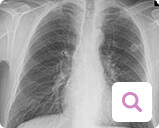 Diagnoseverfahren bei metastasiertem Brustkrebs: Lungenröntgen Diagnoseverfahren bei metastasiertem Brustkrebs: Lungenröntgen