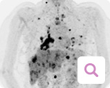 Diagnoseverfahren bei metastasiertem Brustkrebs: Positronenemissionstomographie (PET) Diagnoseverfahren bei metastasiertem Brustkrebs: Positronenemissionstomographie (PET)