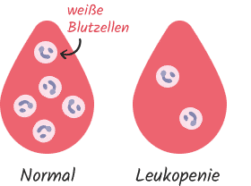 Leukopenie - Absinken der weissen Blutzellen