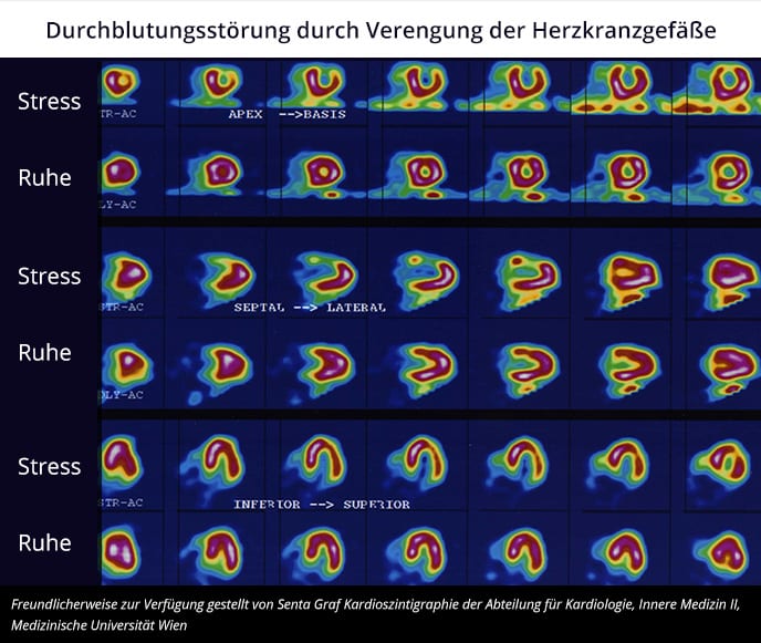 Myokardszinigrafie: Durchblutungsstörung durch Verengung der Herzkranzgefäße