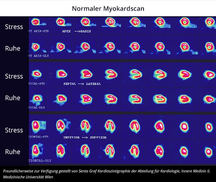 Myokardszinigrafie: Normaler Myokardscan