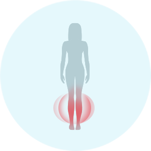 Symptome der Angina pectoris bei Frauen: Ödeme der unteren Extremitäten