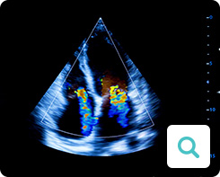 Diagnose der Angina pectoris: Untersuchungsmethode Echokardiografie (Ultraschalluntersuchung) Diagnose der Angina pectoris: Untersuchungsmethode Echokardiografie (Ultraschalluntersuchung)
