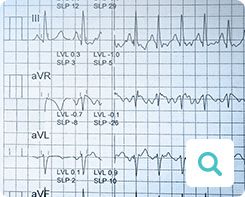 Diagnose der Angina pectoris: Untersuchungsmethode Elektrokardiogramm (EKG) Diagnose der Angina pectoris: Untersuchungsmethode Elektrokardiogramm (EKG)
