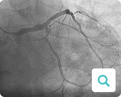 Diagnose der Angina pectoris: Untersuchungsmethode Koronar-Angiografie Diagnose der Angina pectoris: Untersuchungsmethode Koronar-Angiografie