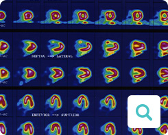 Diagnose der Angina pectoris: Untersuchungsmethode Myokardszintigrafie Diagnose der Angina pectoris: Untersuchungsmethode Myokardszintigrafie
