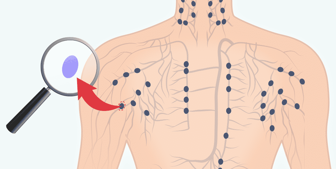 Lymphknotenentnahme