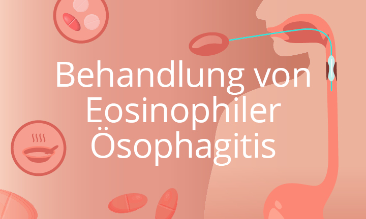 Kursbild_EoE_Behandlung Behandlung von Eosinophiler Ösophagitis
