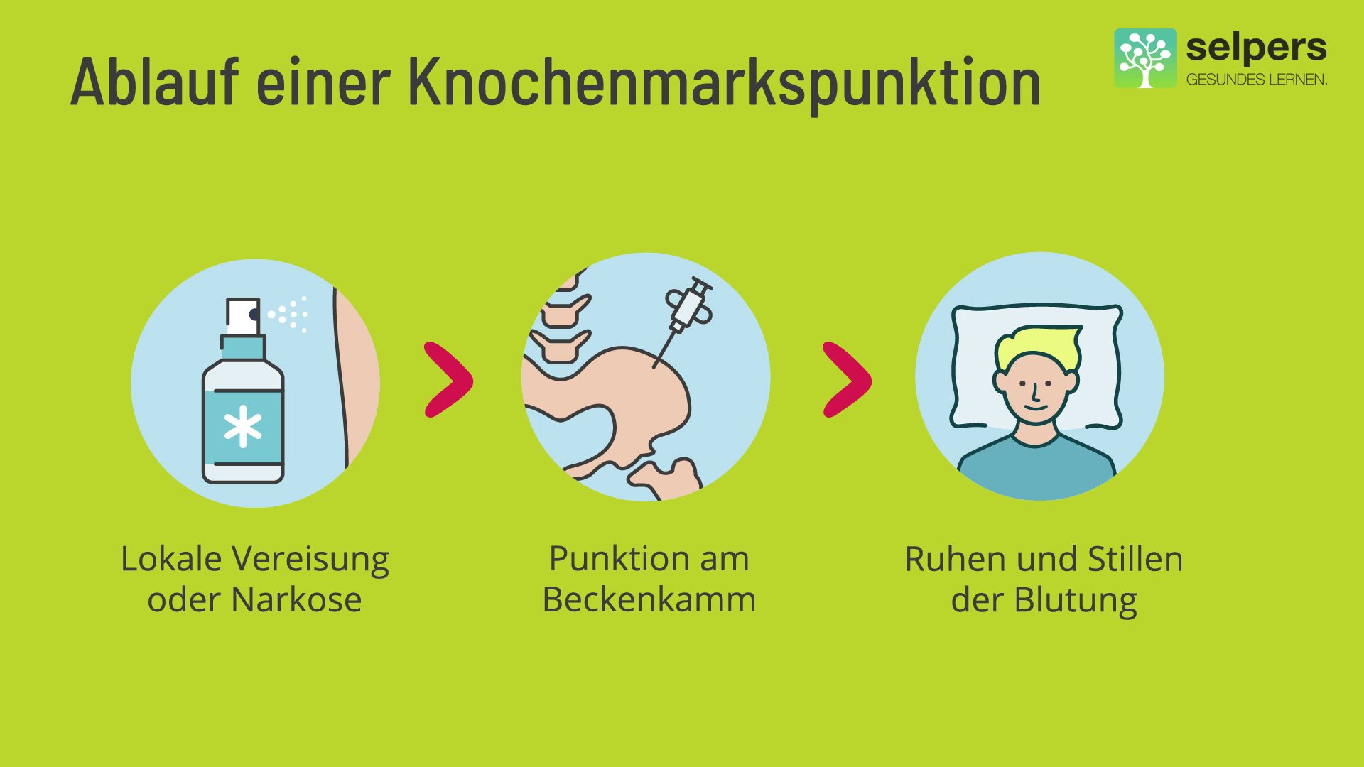 knochenmarkspunktion-morbus-waldenstroem-verstehen Ablauf einer Knochenmarkspunktion