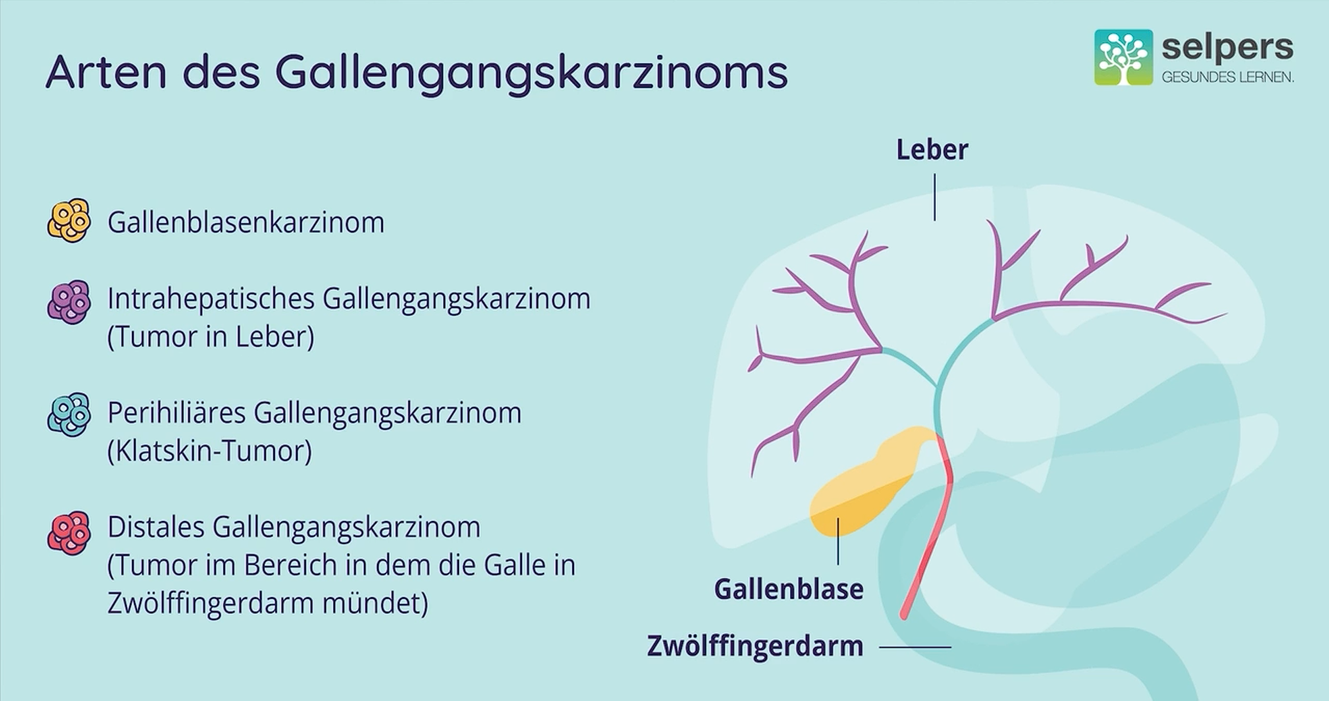 Gallengangskrebs_verstehen_verschiedene_arten_des_karzinoms-selpers Gallengangskrebs verstehen verschiedene Arten des Karzinoms