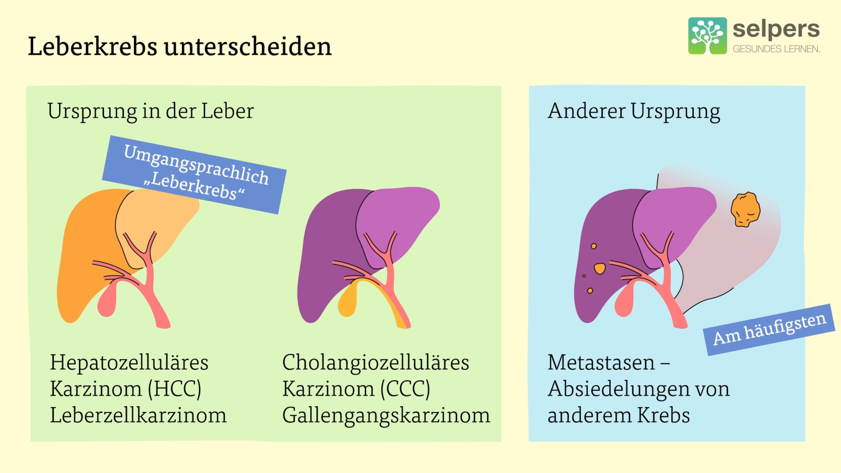 Leberkrebs_verstehen_Leberkrebs_unterscheiden_Arten_von_Leberkrebs_selpers Leberkrebs verstehen Leberkrebs unterscheiden Arten von Leberkrebs