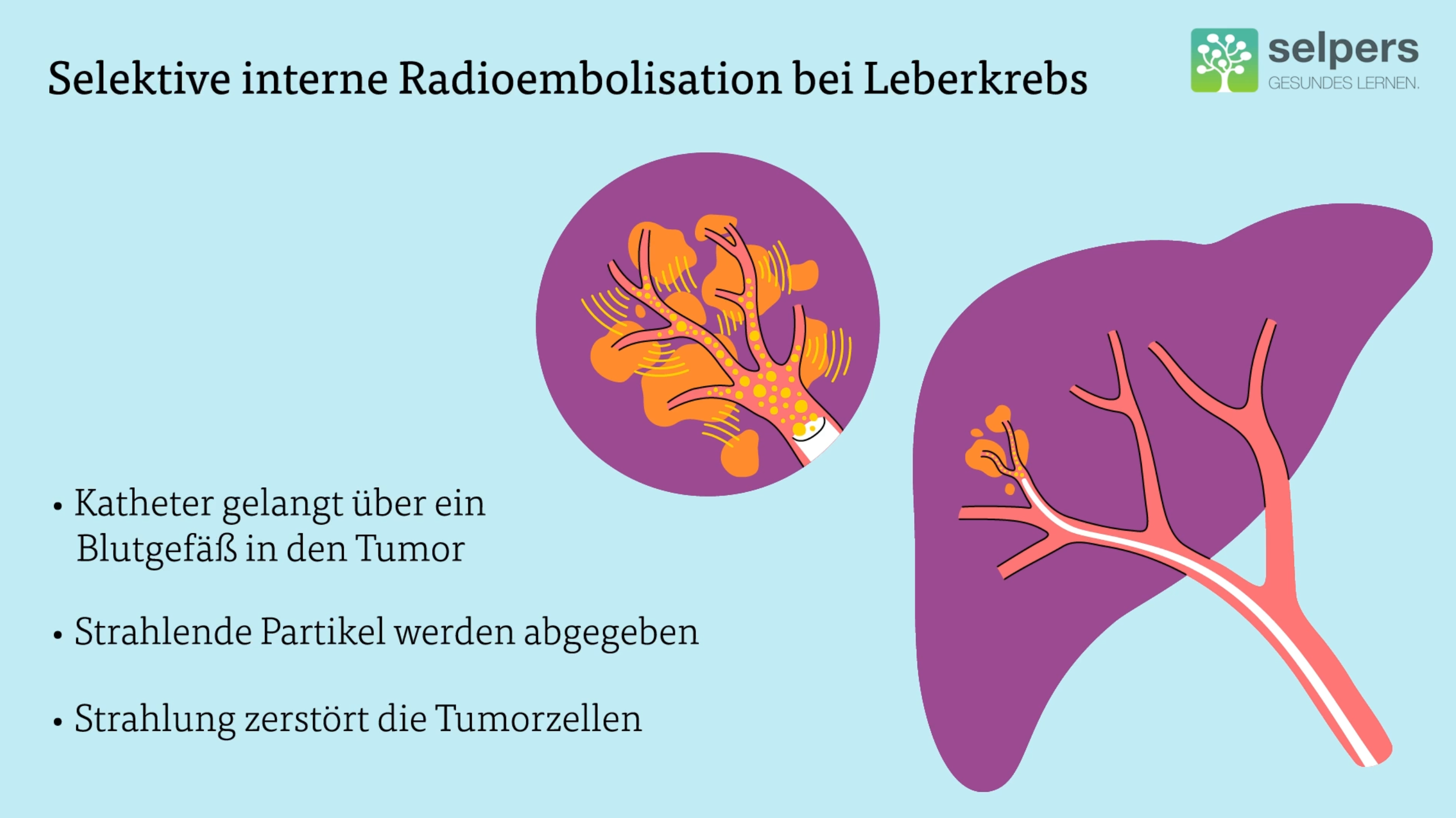 Behanldung_von_Leberkrebs_Selektive_interne_Radioembolisation_Strahlentherapie_bei_Leberkrebs_selpers Behanldung von Leberkrebs Selektive interne Radioembolisation Strahlentherapie bei Leberkrebs