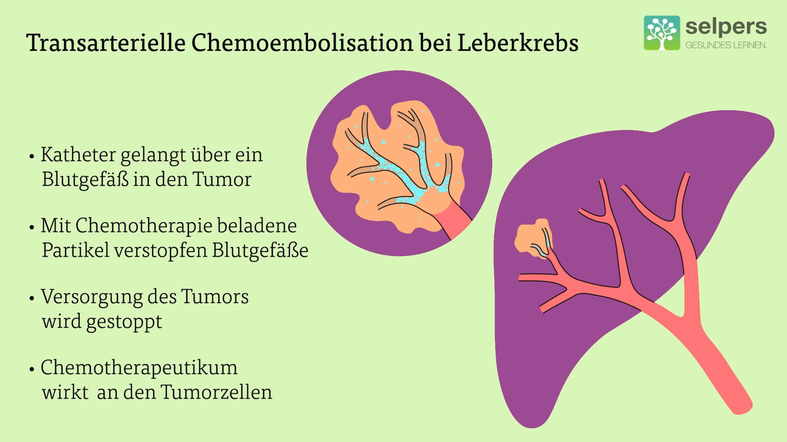 Behandlung_von_Leberkrebs_Transarterielle_Chemoembolisation_Lokale_Therapie_bei_Leberkrebs_selpers Behandlung von Leberkrebs Transarterielle Chemoembolisation lokale Therapie bei Leberkrebs