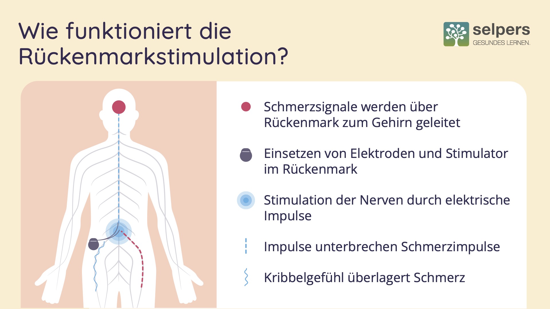 Minimalinvasive Methoden_Rückenmarkstimulation