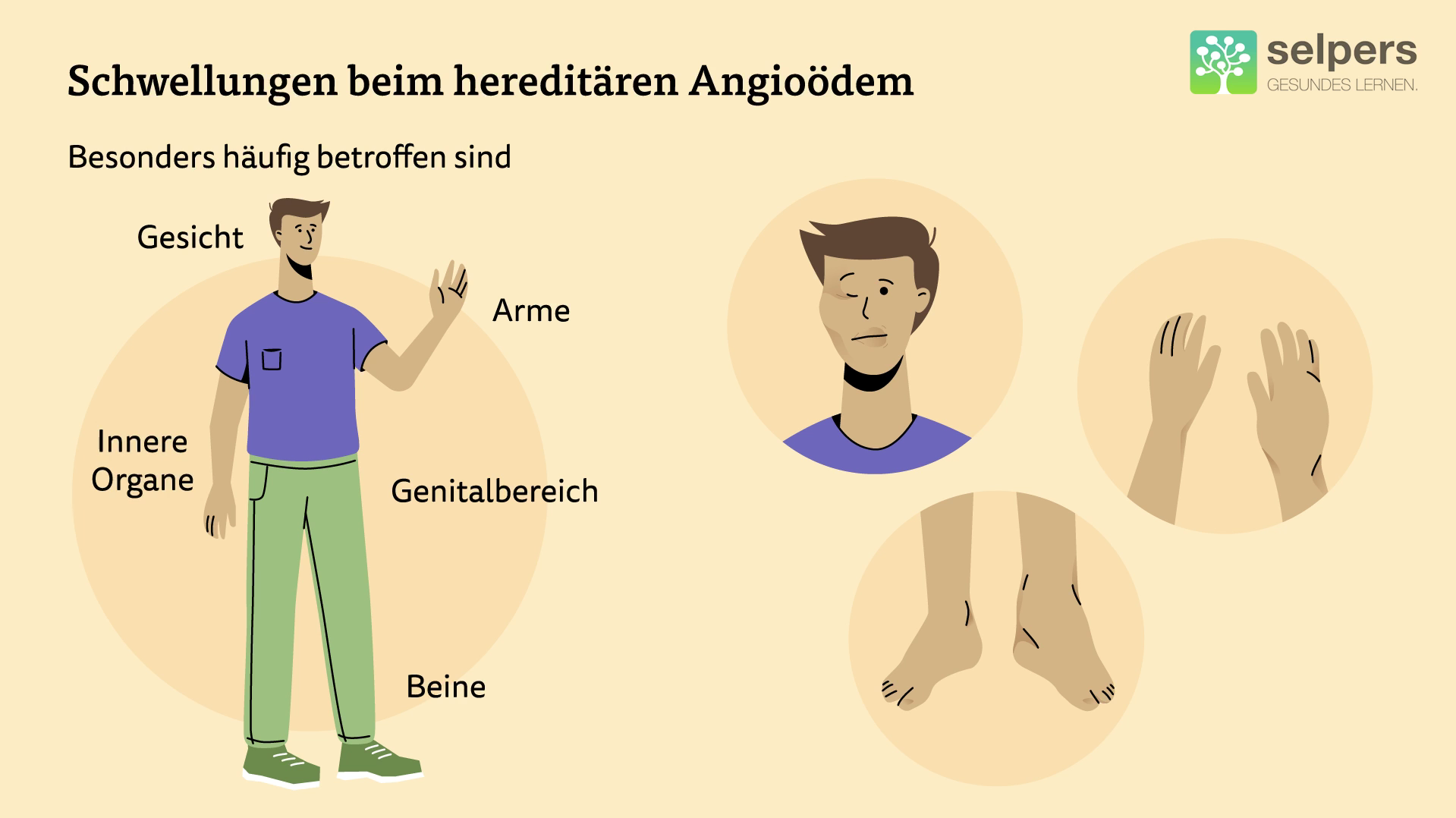 Schwellungen_beim_hereditären_angioödem_kursbild_mit_text_selpers Bilder von Schwellungen beim hereditären Angioödem - Arme, Beine, inneren Organe und Genitalbereich