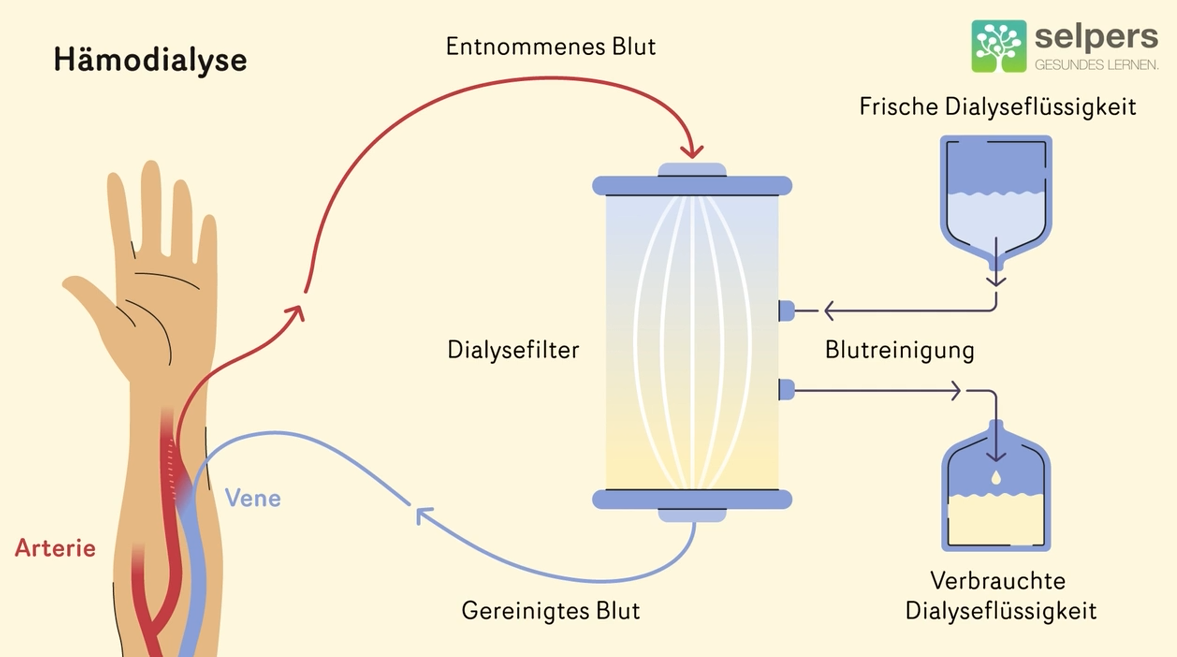 Hämodialyse-Dialyse-und-Juckreiz