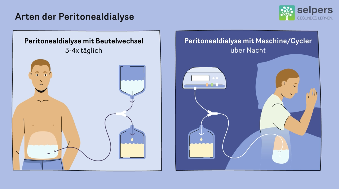 Arten-der-Peritonealdialyse-Dialyse-und-Juckreiz